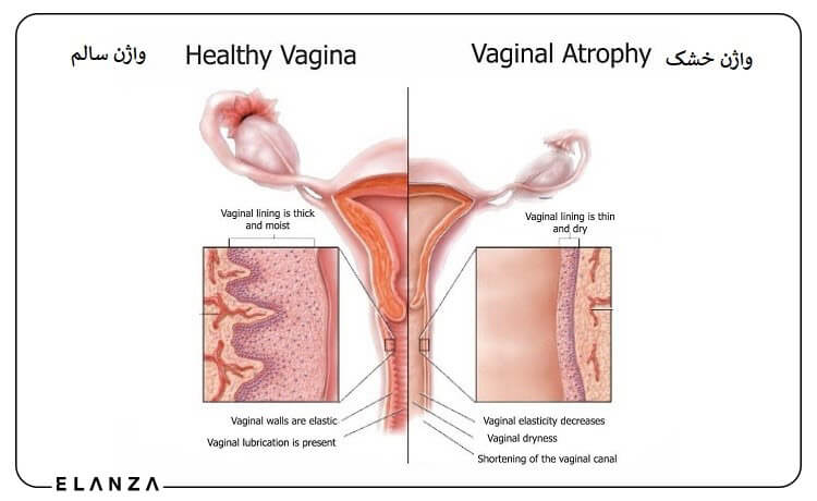 درمان خشکی واژن چیست