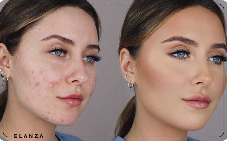 نحوه پوشاندن جای جوش با آرایش