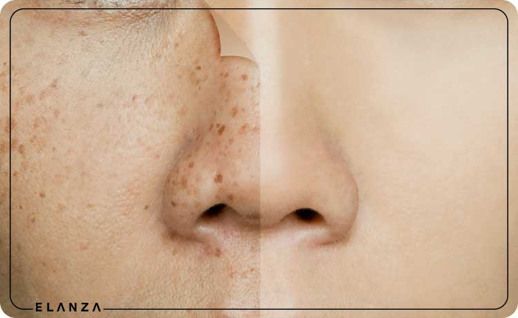 درمان خانگی لکه های قهوه ای روی صورت