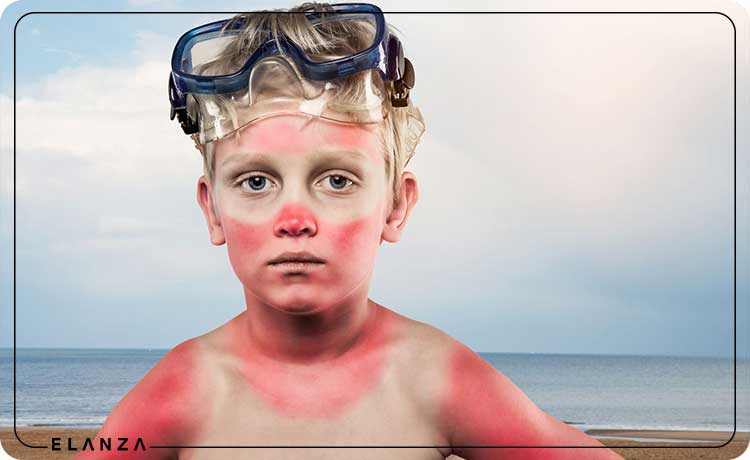 رفع تیرگی پوست کودک در اثر آفتاب سوختگی