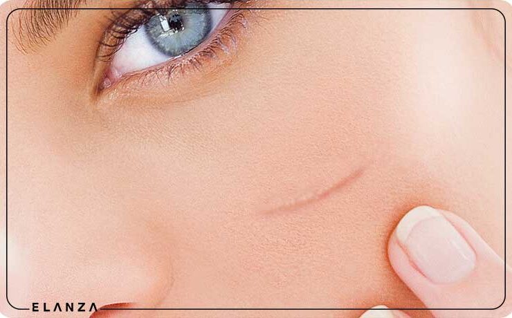 چگونه جای زخم را بپوشانیم
