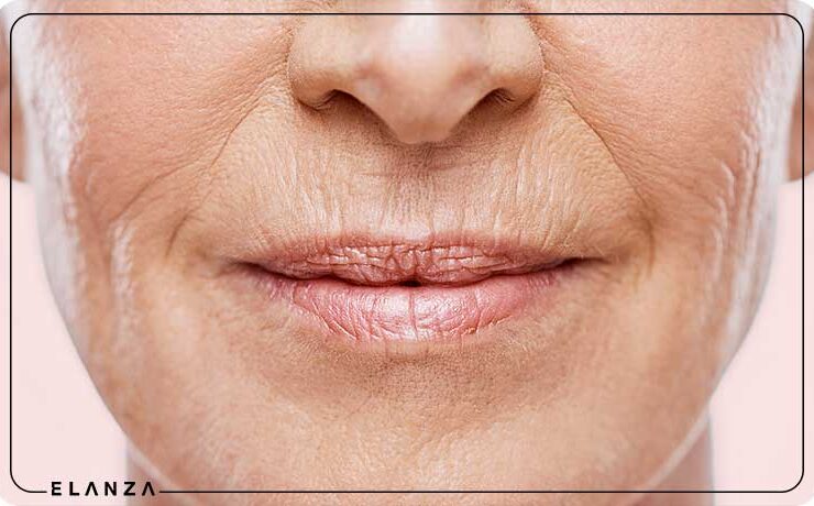 روش های از بین بردن چروک دور لب
