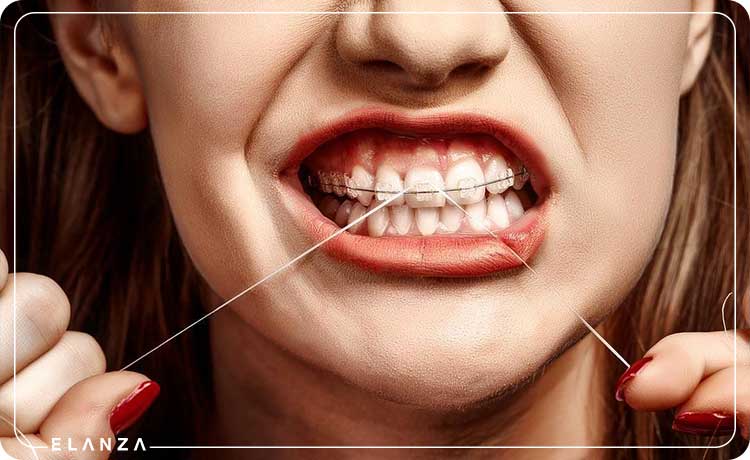 روش صحیح نخ دندان کشیدن در ارتودنسی